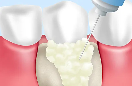 歯周組織を再生させるエムドゲイン療法
