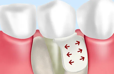 歯周組織の再生スペースを確保するGTR法