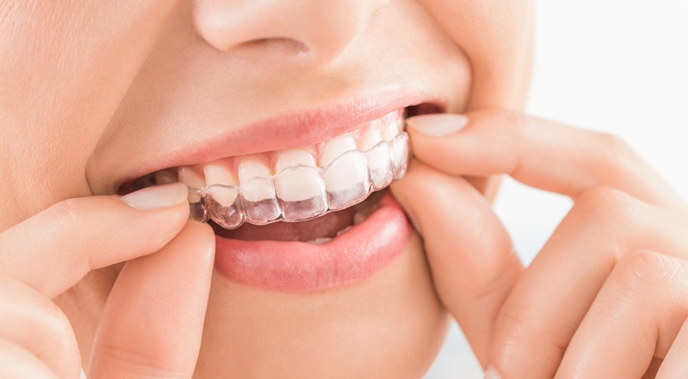 保定装置（リテーナー）の装着不足